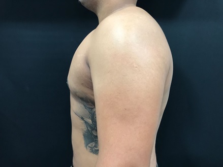4 months after treatment for man boobs (gynaecomastia)
